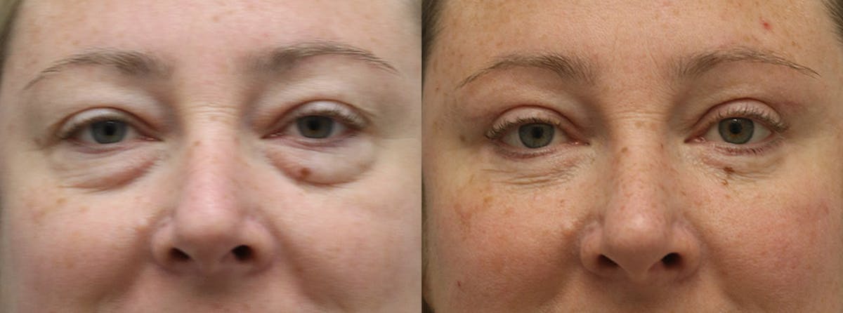 Eyelids Before & After Gallery - Patient 246871 - Image 1