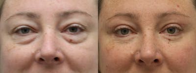 Eyelids Before & After Gallery - Patient 246871 - Image 1
