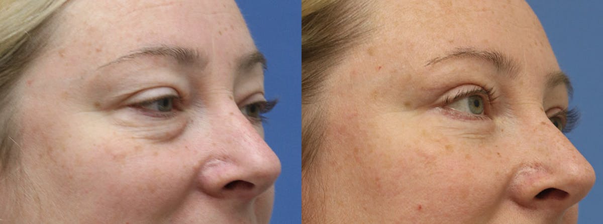 Eyelids Before & After Gallery - Patient 246871 - Image 2