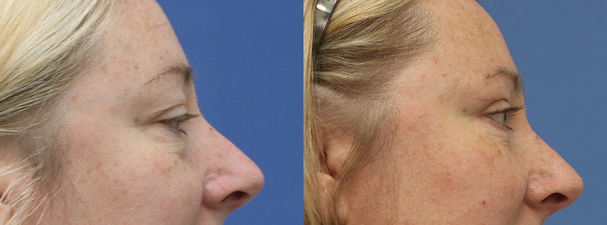 Eyelids Before & After Gallery - Patient 246871 - Image 3