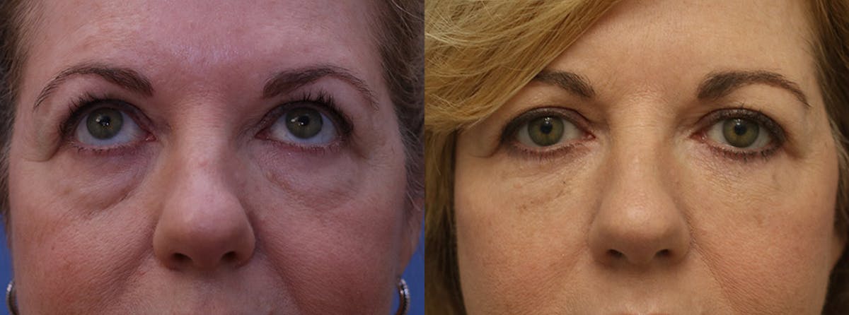 Eyelids Before & After Gallery - Patient 411160 - Image 1