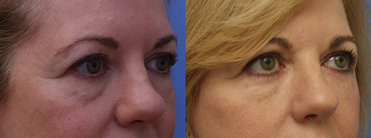 Eyelids Before & After Gallery - Patient 411160 - Image 2