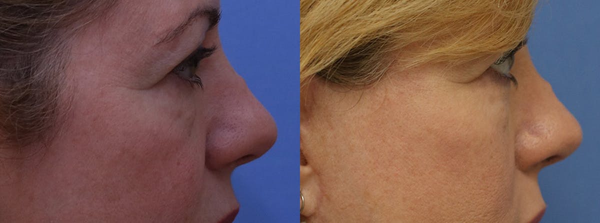 Eyelids Before & After Gallery - Patient 411160 - Image 3