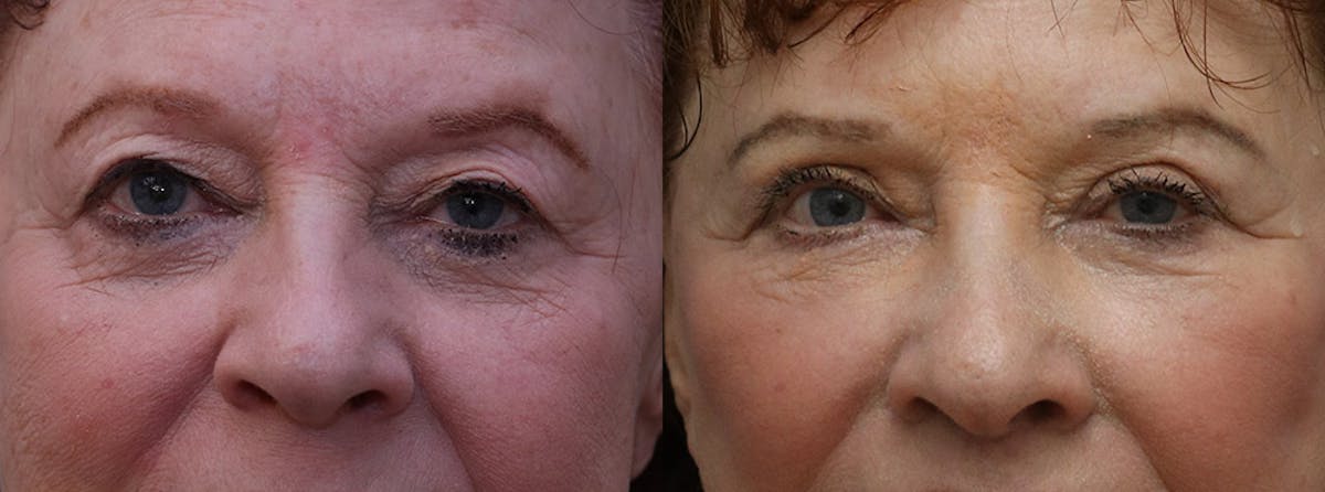 Eyelids Before & After Gallery - Patient 655496 - Image 1