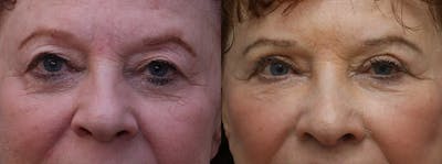 Eyelids Before & After Gallery - Patient 655496 - Image 1