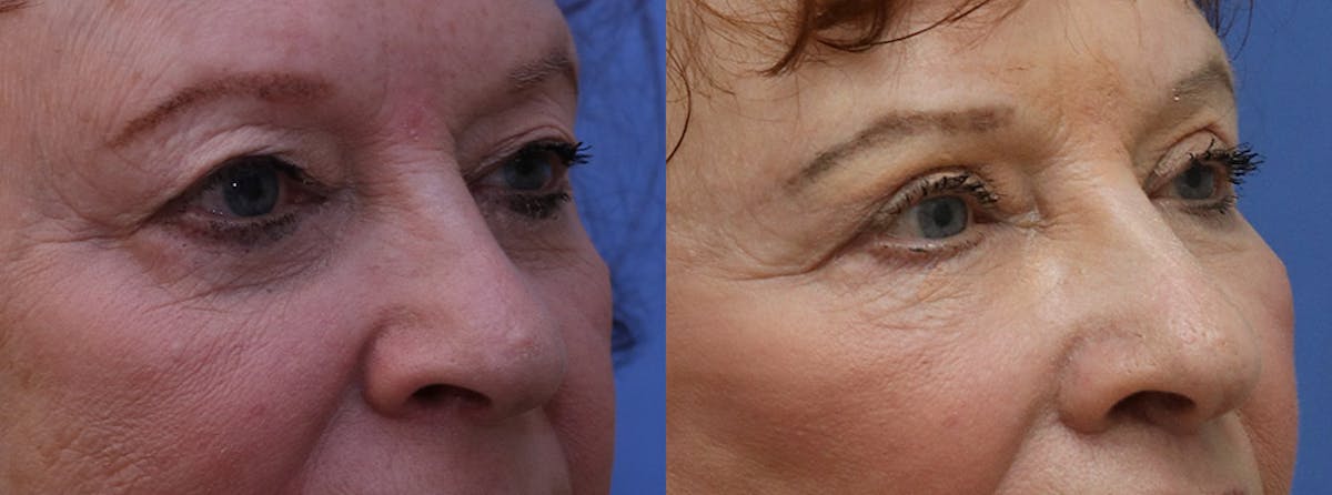 Eyelids Before & After Gallery - Patient 655496 - Image 2
