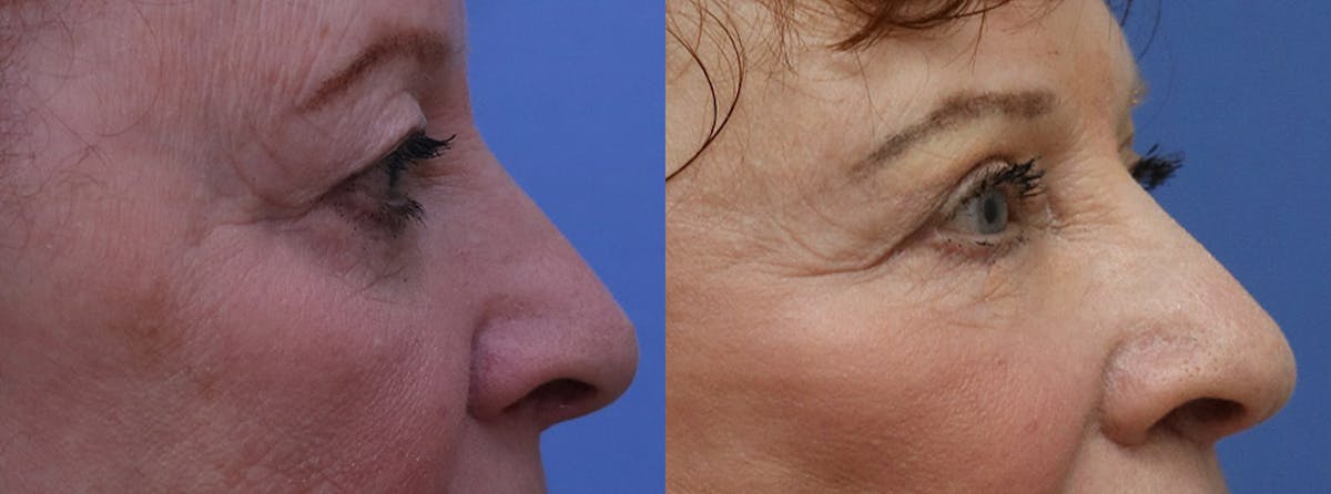 Eyelids Before & After Gallery - Patient 655496 - Image 3
