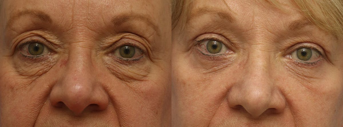 Eyelids Before & After Gallery - Patient 250228 - Image 1
