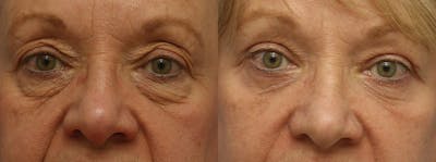 Eyelids Before & After Gallery - Patient 250228 - Image 1