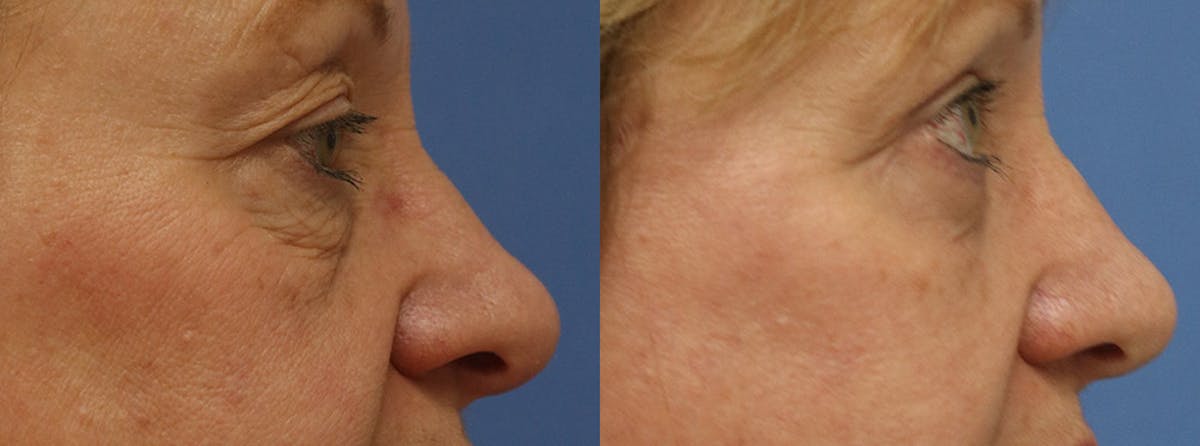 Eyelids Before & After Gallery - Patient 250228 - Image 2