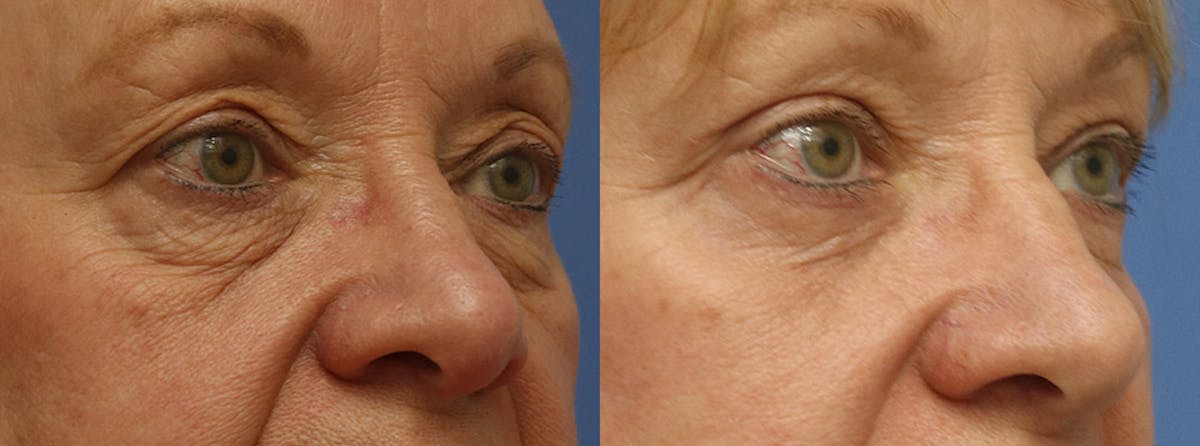 Eyelids Before & After Gallery - Patient 250228 - Image 3