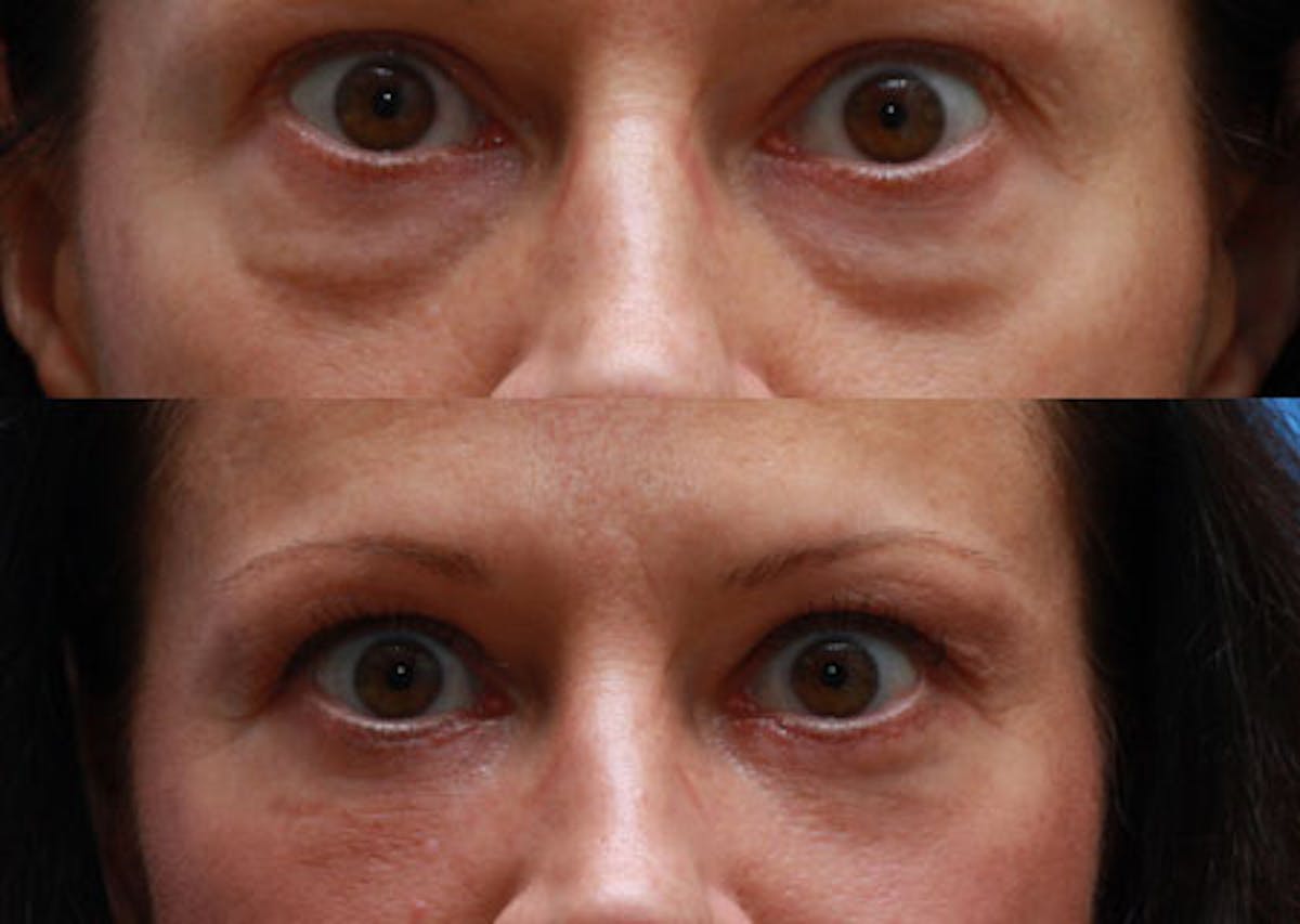 Eyelids Before & After Gallery - Patient 140065 - Image 1