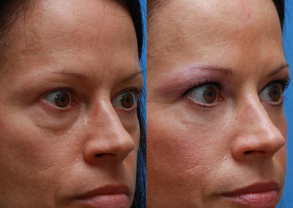 Eyelids Before & After Gallery - Patient 140065 - Image 2