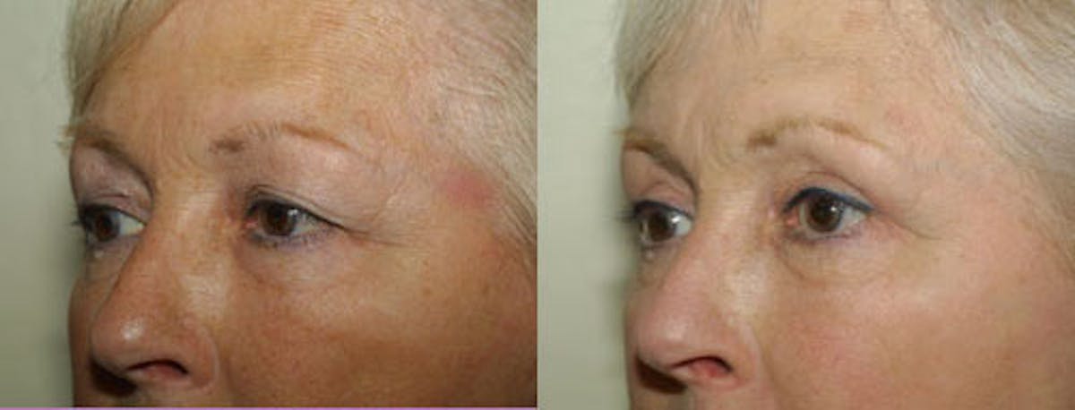 Eyelids Before & After Gallery - Patient 402535 - Image 1