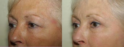 Eyelids Before & After Gallery - Patient 402535 - Image 1