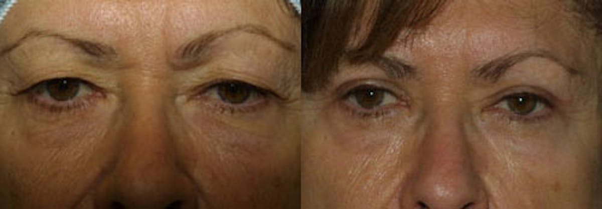 Eyelids Before & After Gallery - Patient 173528 - Image 1