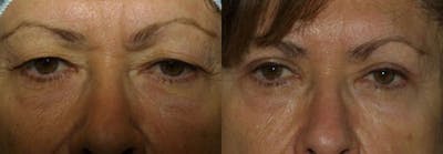 Eyelids Before & After Gallery - Patient 173528 - Image 1