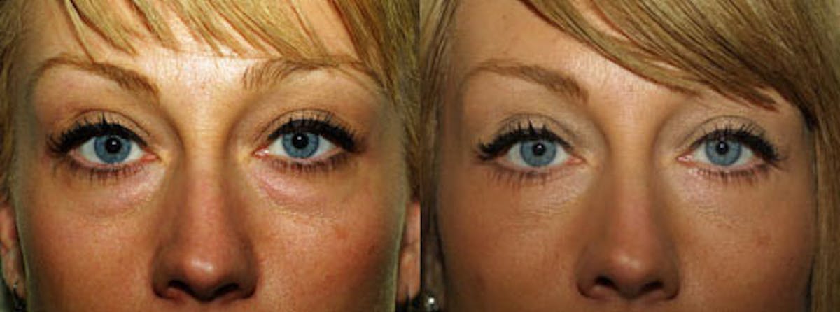 Eyelids Before & After Gallery - Patient 174451 - Image 1