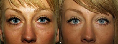 Eyelids Before & After Gallery - Patient 174451 - Image 1