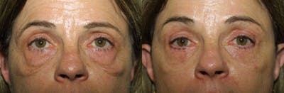 Eyelids Before & After Gallery - Patient 152253 - Image 1