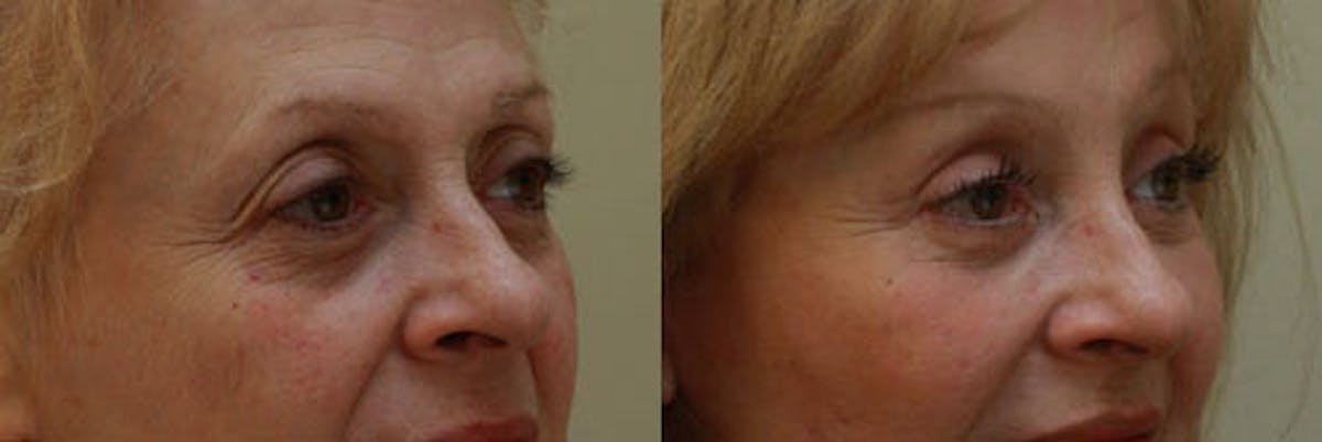 Eyelids Before & After Gallery - Patient 188445 - Image 1