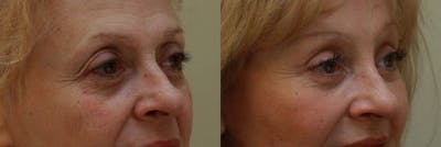 Eyelids Before & After Gallery - Patient 188445 - Image 1
