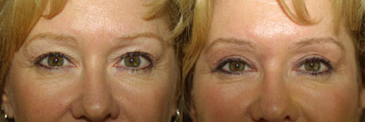 Eyelids Before & After Gallery - Patient 255734 - Image 1