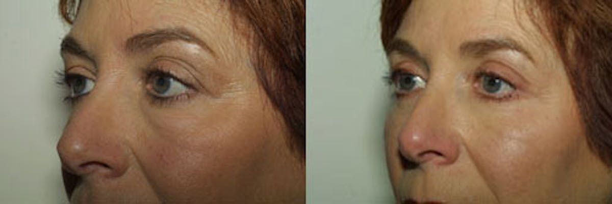 Eyelids Before & After Gallery - Patient 225588 - Image 1