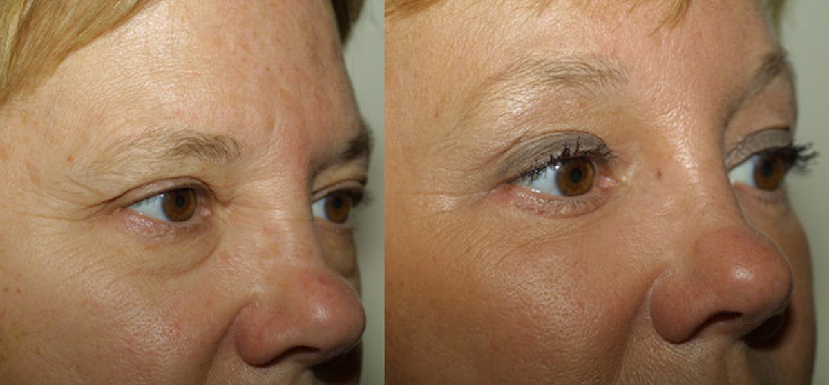 Eyelids Before & After Gallery - Patient 413498 - Image 1