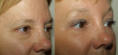 Eyelids Before & After Gallery - Patient 413498 - Image 1