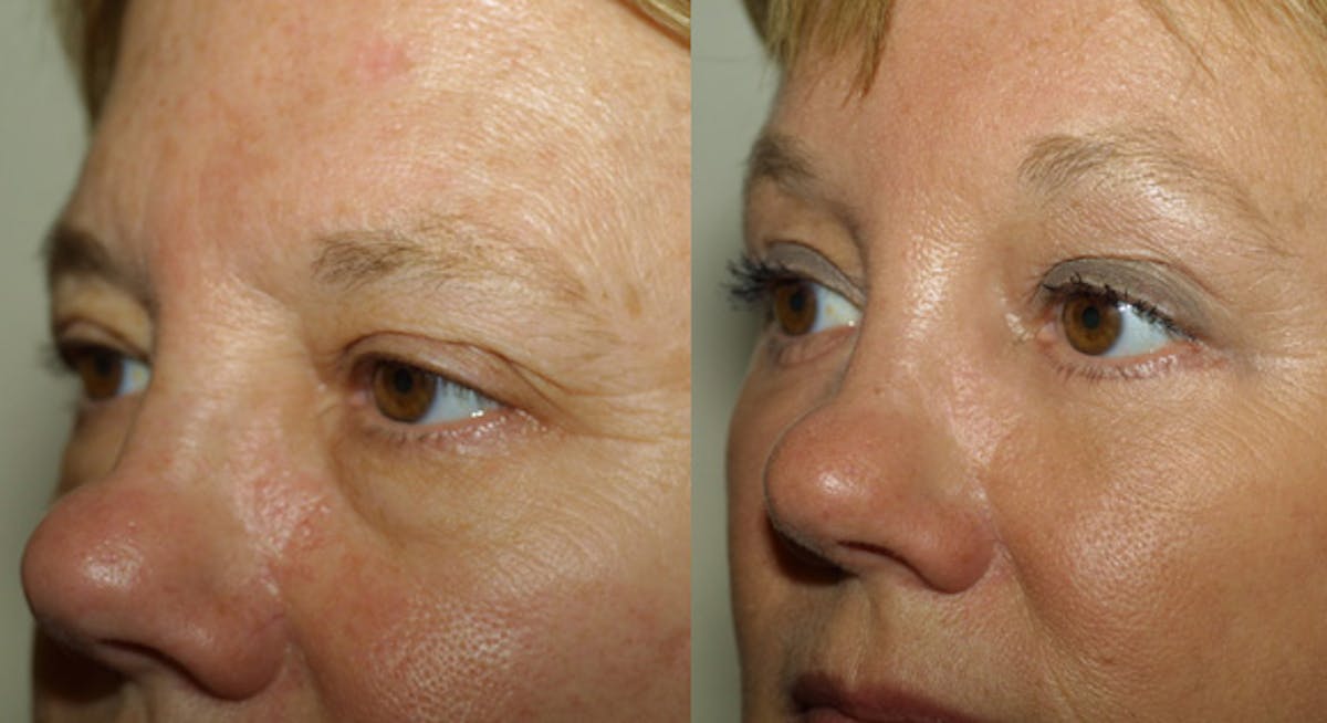 Eyelids Before & After Gallery - Patient 413498 - Image 2