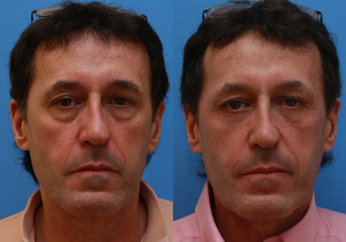 Eyelids Before & After Gallery - Patient 366985 - Image 1
