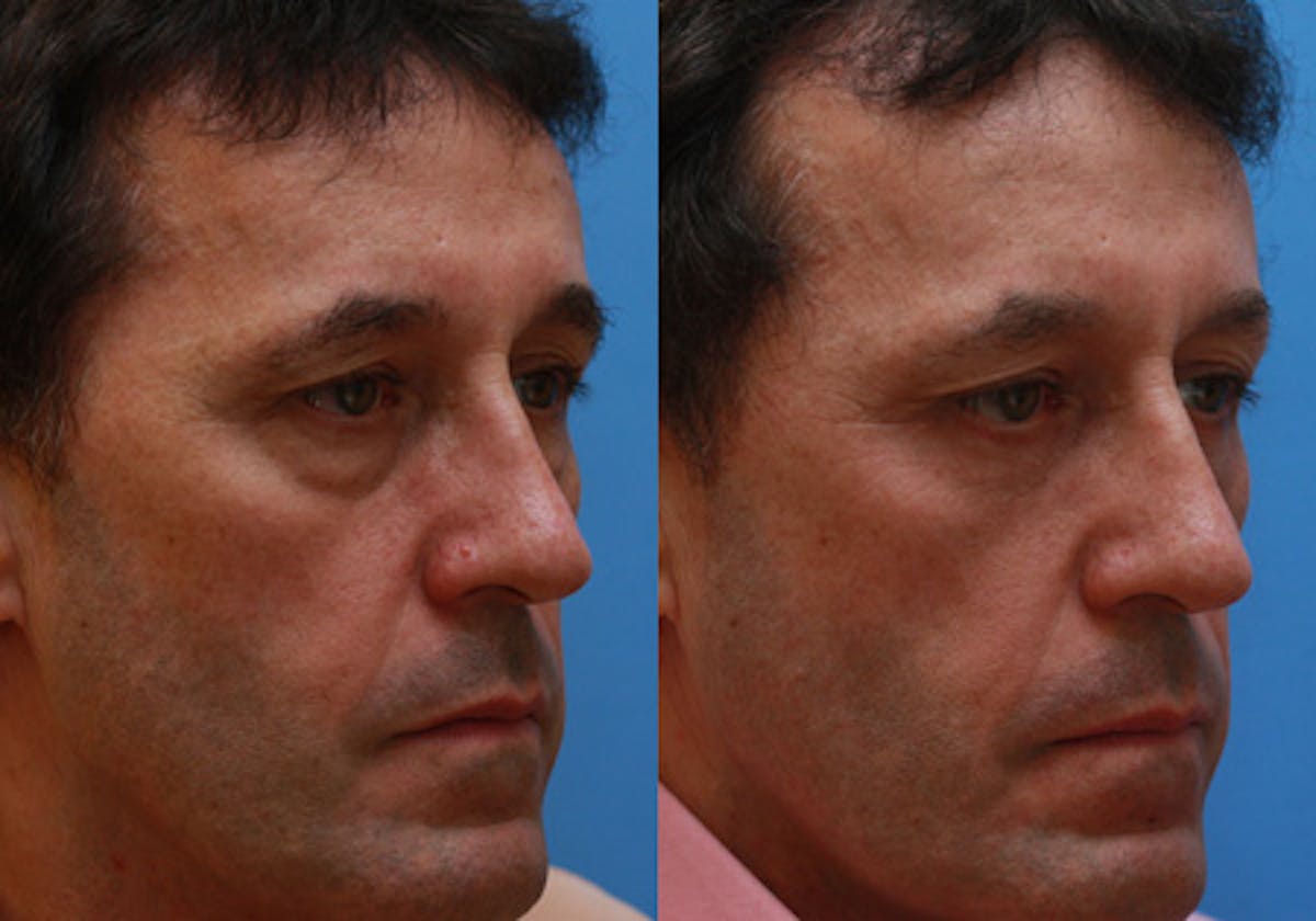 Eyelids Before & After Gallery - Patient 366985 - Image 2