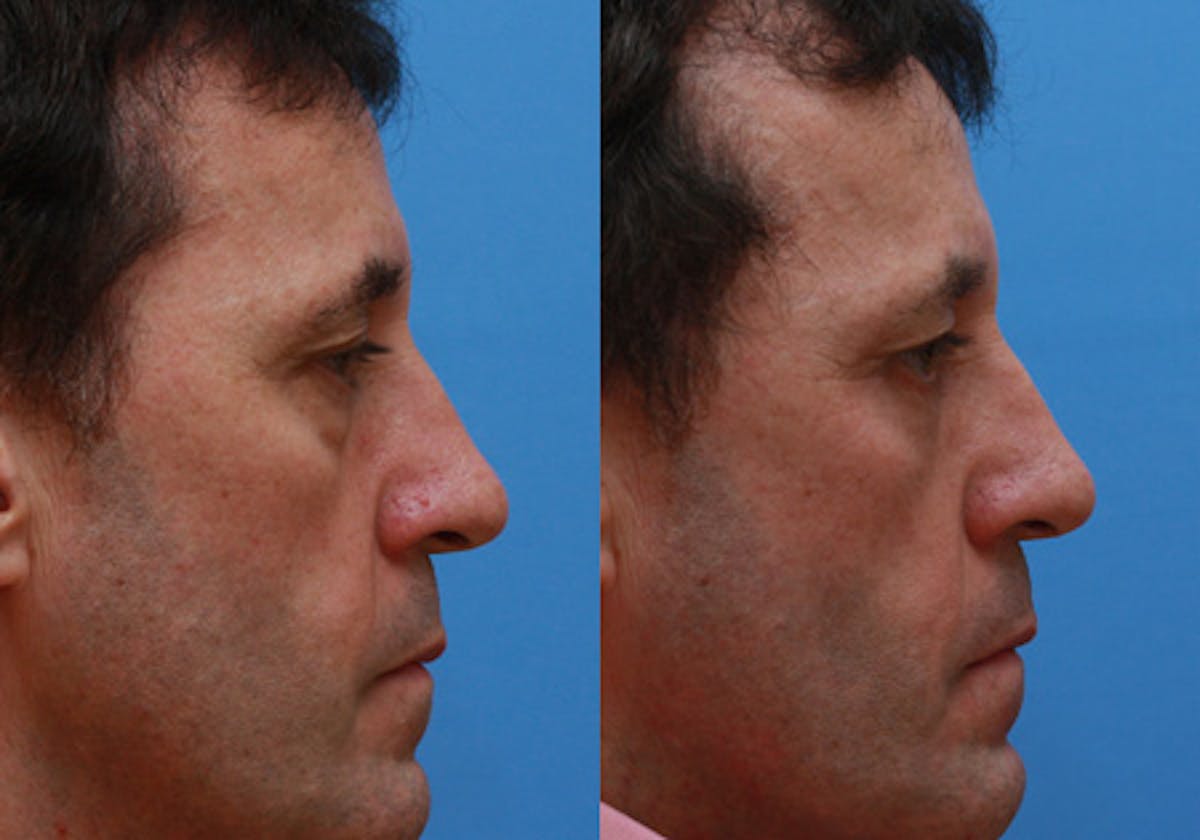 Eyelids Before & After Gallery - Patient 366985 - Image 3