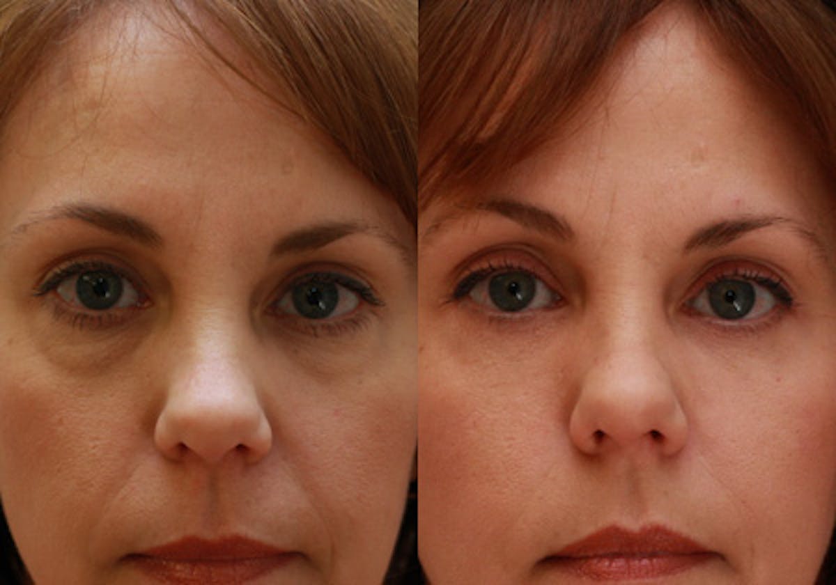 Eyelids Before & After Gallery - Patient 364708 - Image 1