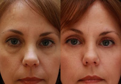 Eyelids Before & After Gallery - Patient 364708 - Image 1