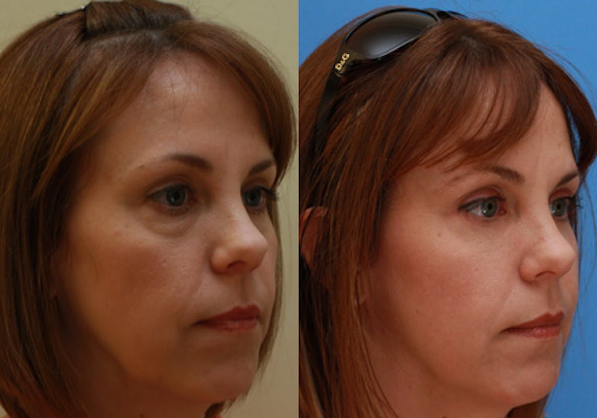 Eyelids Before & After Gallery - Patient 364708 - Image 2