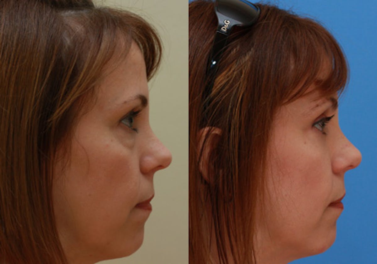 Eyelids Before & After Gallery - Patient 364708 - Image 3