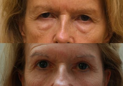 Eyelids Before & After Gallery - Patient 212115 - Image 1