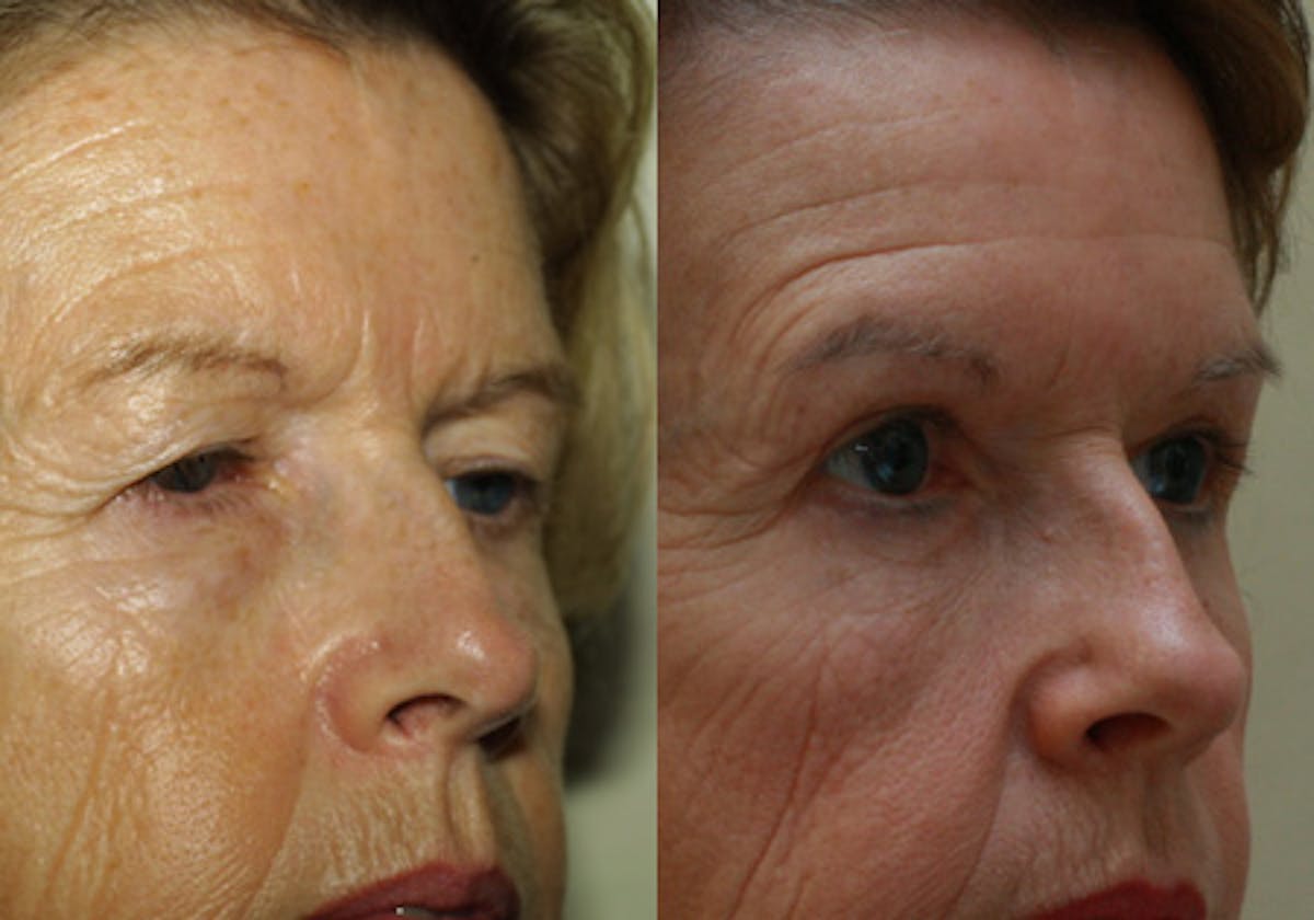 Eyelids Before & After Gallery - Patient 212115 - Image 2