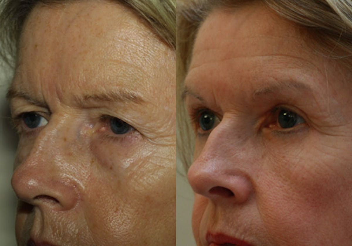 Eyelids Before & After Gallery - Patient 212115 - Image 3