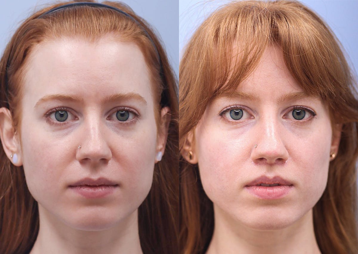 Lip Lift Before & After Gallery - Patient 177165 - Image 1