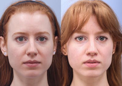 Lip Lift Before & After Gallery - Patient 177165 - Image 1