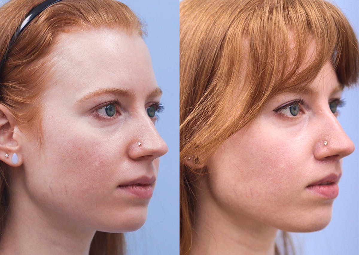 Lip Lift Before & After Gallery - Patient 177165 - Image 2