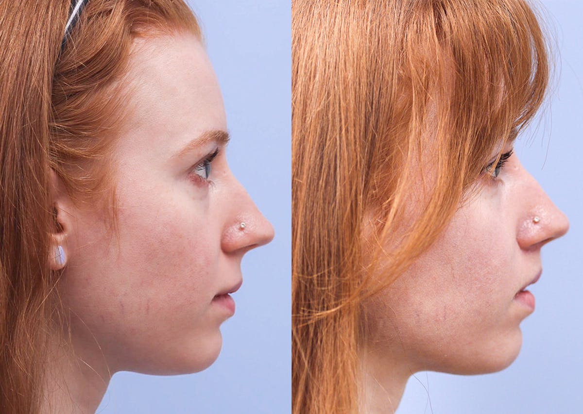 Lip Lift Before & After Gallery - Patient 177165 - Image 3