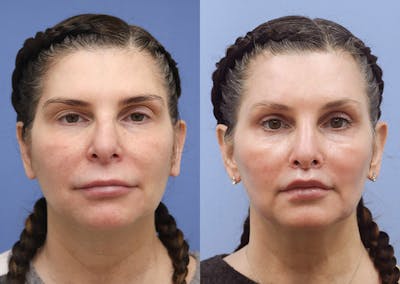 Lip Lift Before & After Gallery - Patient 321175 - Image 1