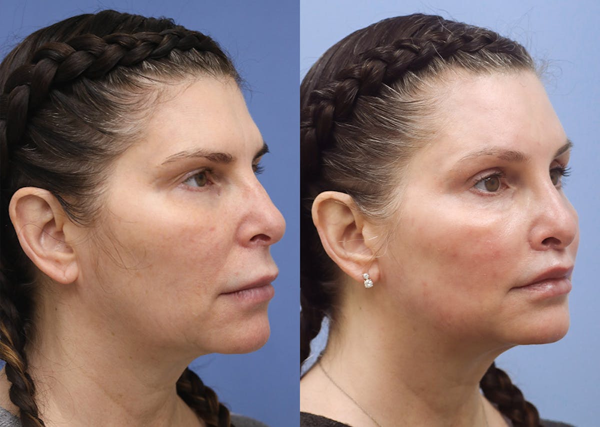 Lip Lift Before & After Gallery - Patient 321175 - Image 2