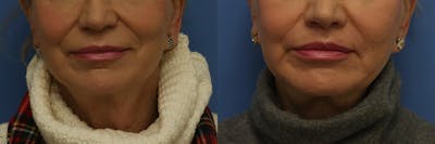 Lip Lift Before & After Gallery - Patient 204424 - Image 1