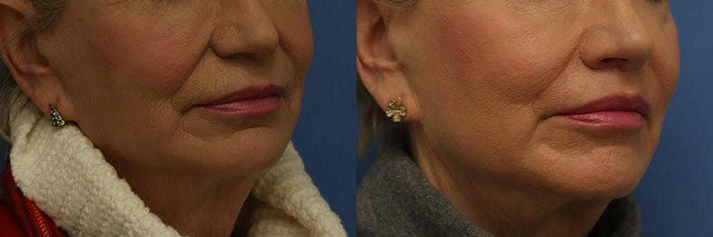 Lip Lift Before & After Gallery - Patient 204424 - Image 2