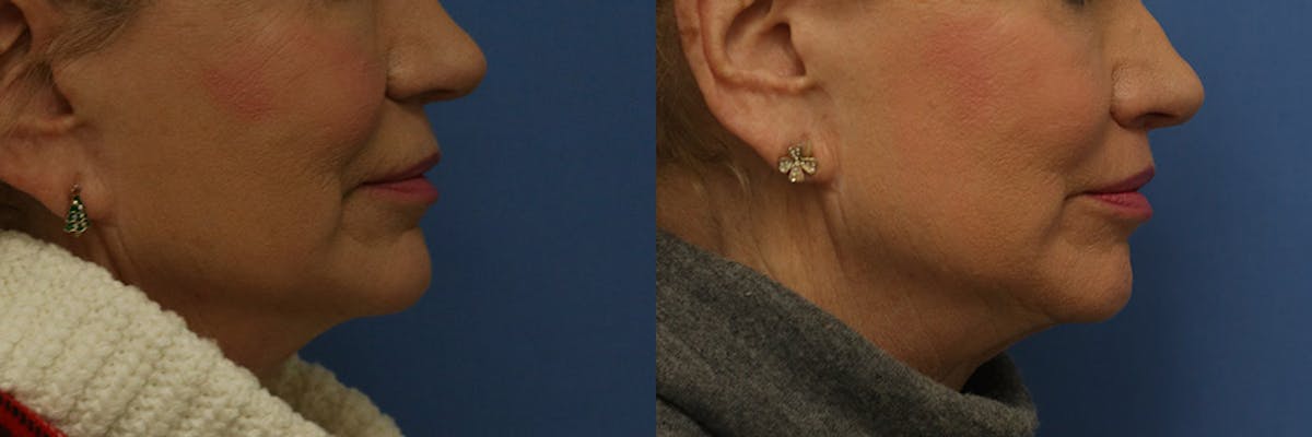 Lip Lift Before & After Gallery - Patient 204424 - Image 3
